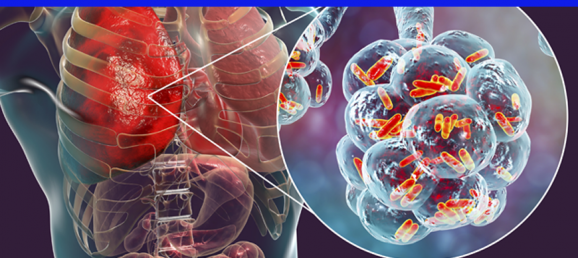 [ARTICLE] Find out how Coriolis  was used to monitor Legionellosis in healthcare facilities Bertin Technologies 60140